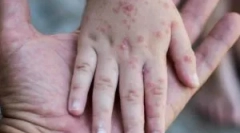 Świerzby: patogen, objawy i leczenie